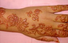 Réaction cutanée sévère après un tatouage au henné noir.