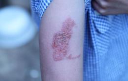 Réaction cutanée après un tatouage au henné noir .